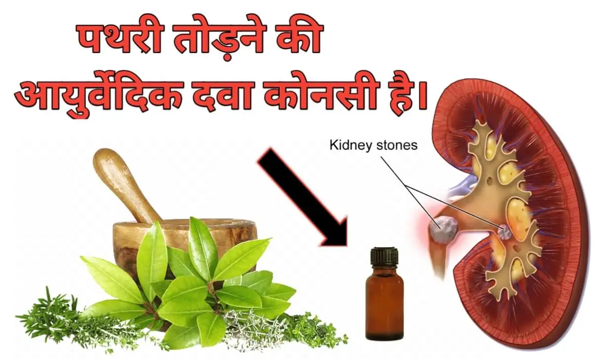 पथरी से परेशान तो लीजिए दवाई-Kidney Stone Medicine